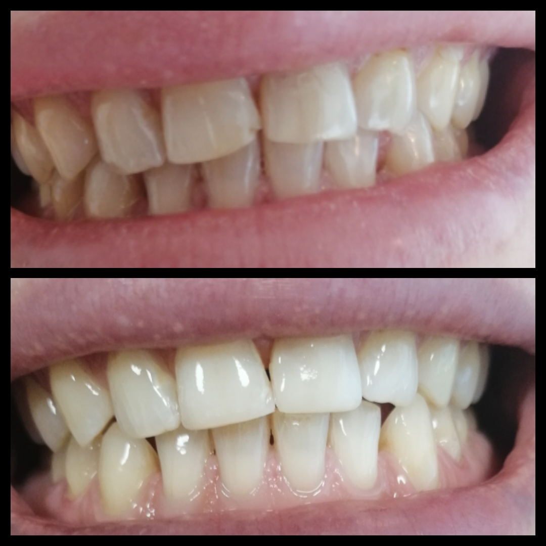 Λεύκανση & Αισθητική