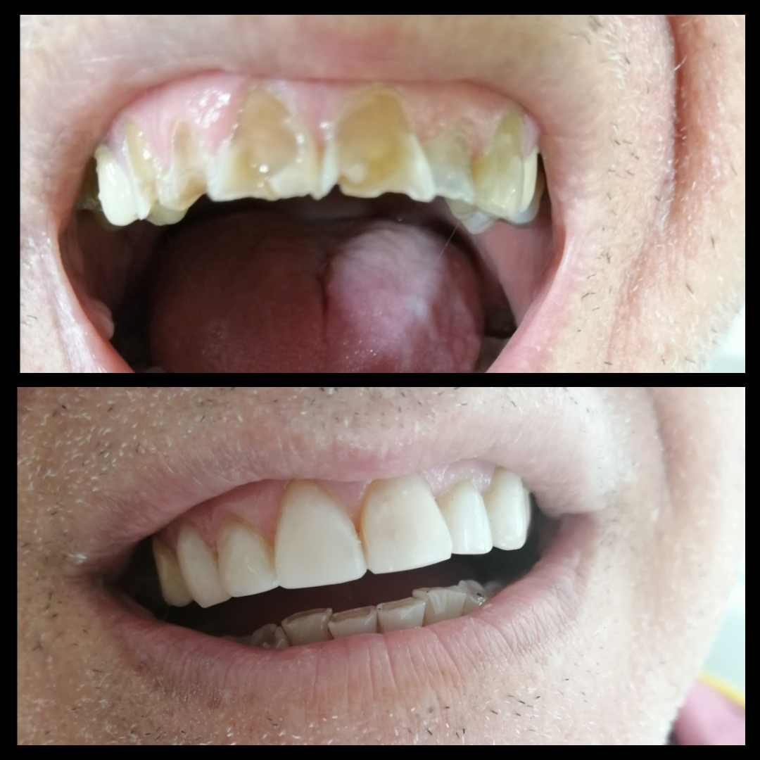 Αποχρωματισμένων Δοντιών