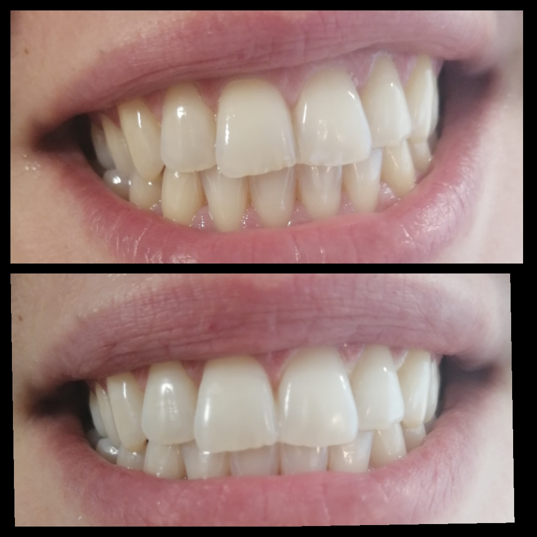 Αποκατάσταση Χαμόγελου