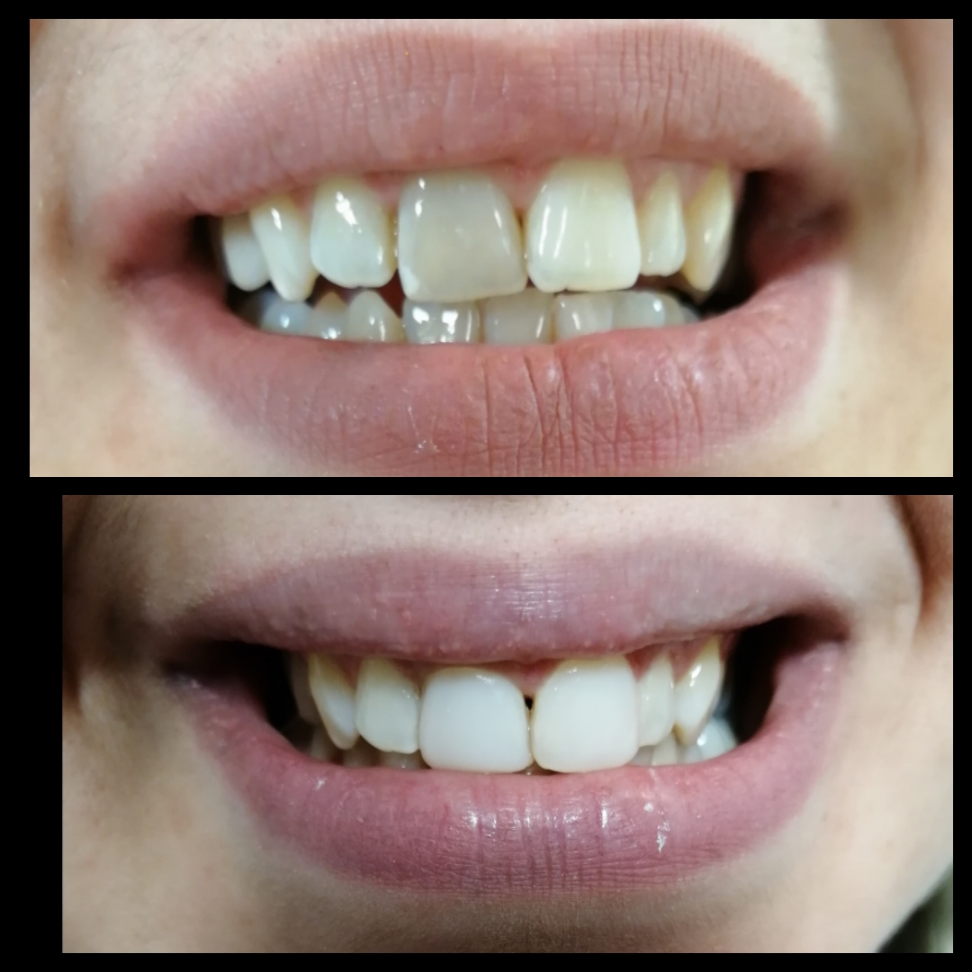 Αποκατάσταση Μπροστινών Δοντιών