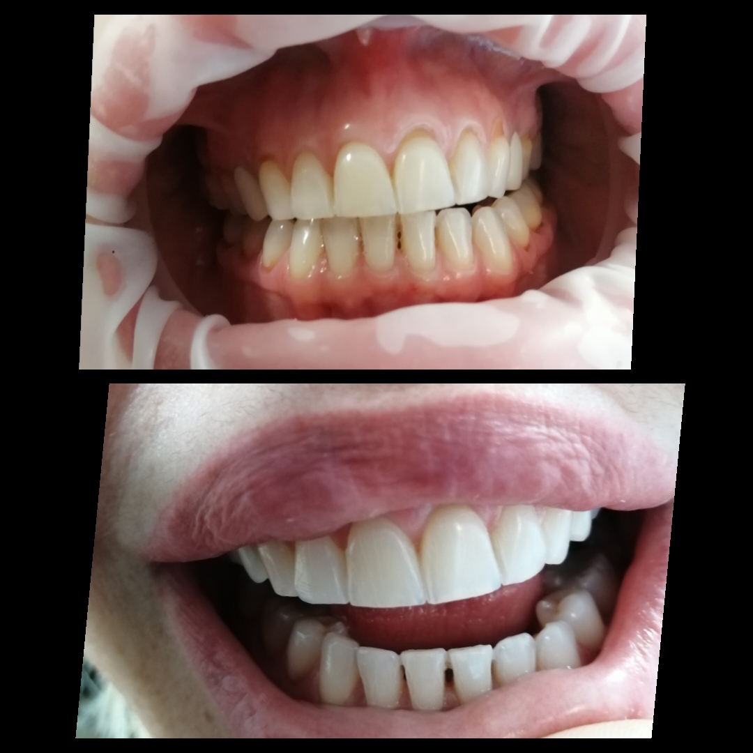 Κεραμικές Όψεις