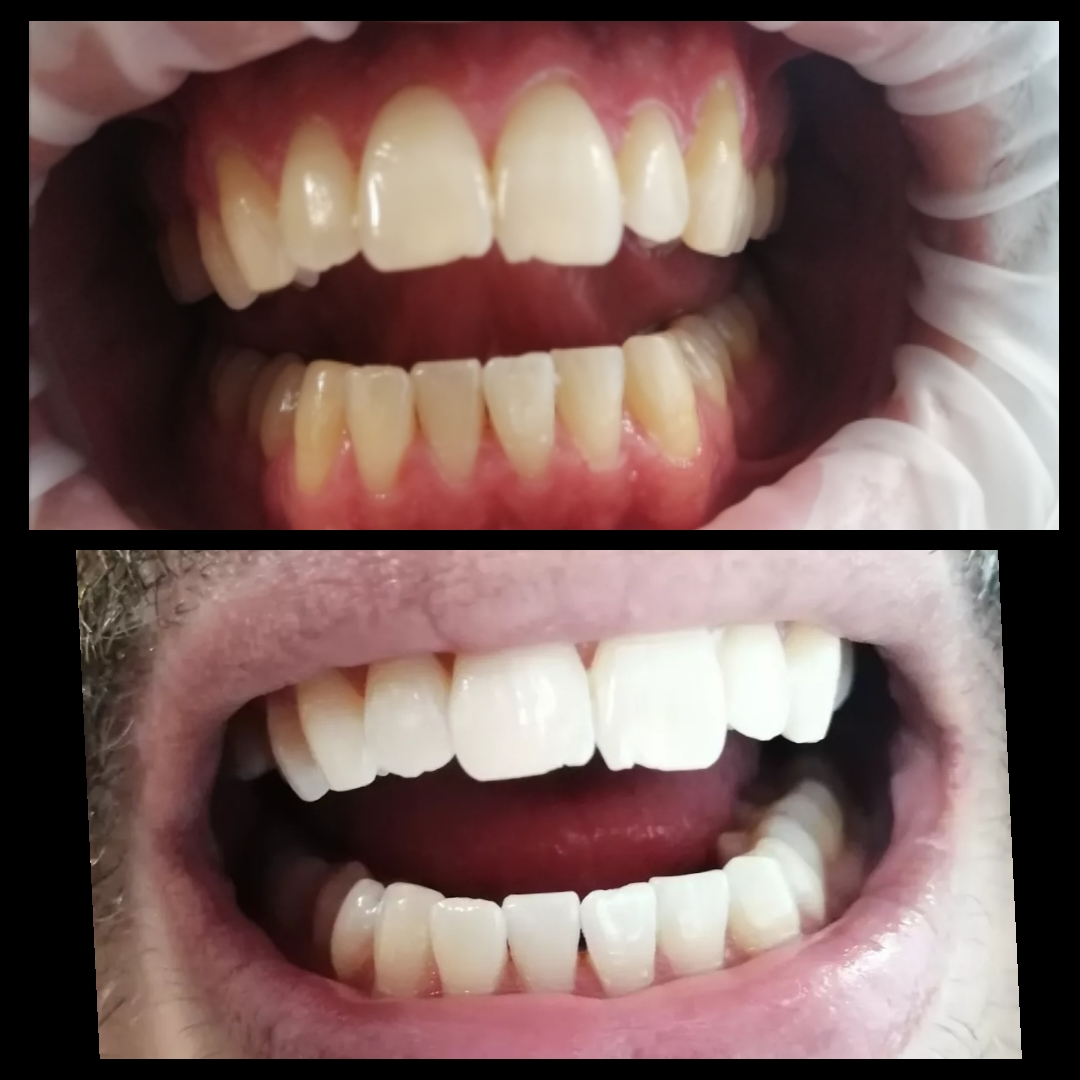 Αποκατάσταση με Όψεις