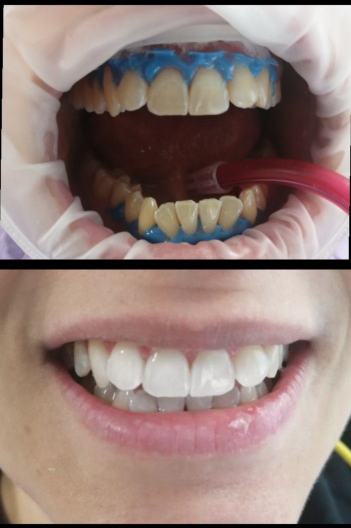 Πλήρης Αποκατάσταση Χαμόγελου