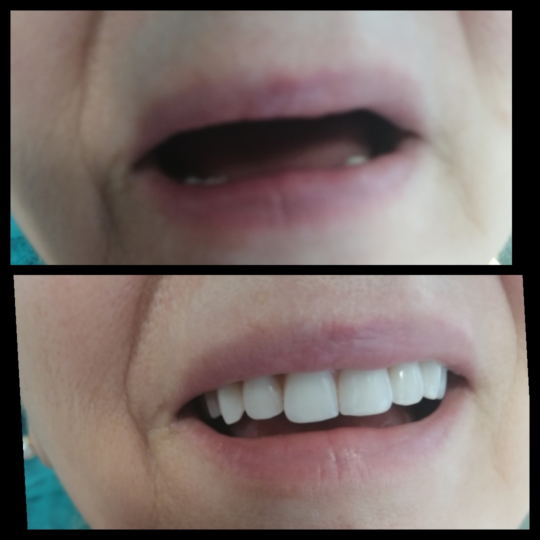 Λεύκανση Δοντιών